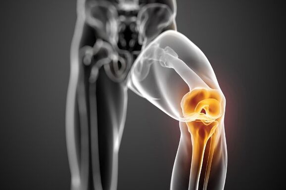 Arthrosis vum Knéi Gelenk
