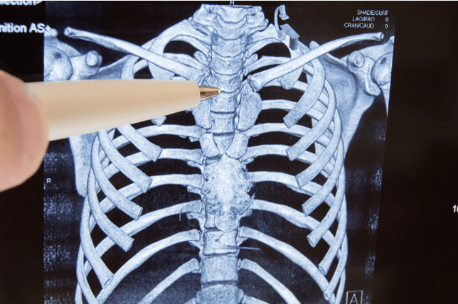 Osteochonds