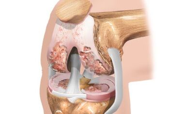 Arthrosis vum Knéi Gelenk