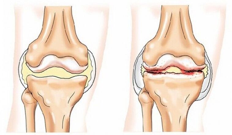 Gesond Gelenk a Gelenk betraff vun Arthrosis