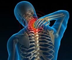osteochondrosis vun der cervical Wirbelsail