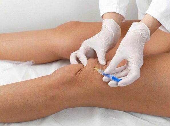 intraartikulär Injektioun fir Kniearthrose