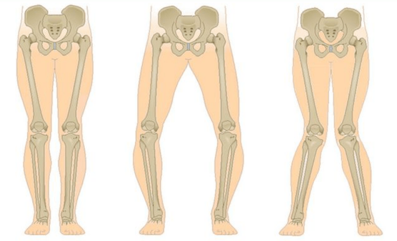 Komplikatioune vun der Kniearthrose