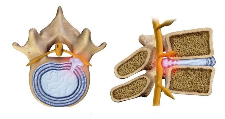 Intervertebral Disc Herniation – Protrusioun vum Disc Kär an de Spinalkanal